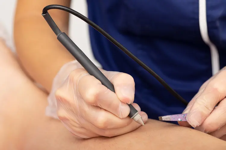Breaking Free from Waxing: The Long-Term Benefits of Electrolysis for Body Hair